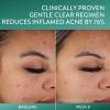imageCetaphil Acne Clearing Kit  Clarifying Acne Cream Cleanser 42 oz ampamp Mattifying Acne Moisturizer 3 oz with Salicylic Acid Deep Clean Hydrate and Treat Sensitive Acne Prone Skin