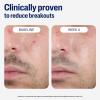 imageCetaphil Gentle Clear ComplexionClearing BPO Acne Cleanser with 26 Benzoyl Peroxide Creamy and Soothing for Sensitive Skin Suitable for All Skin Types 42oz