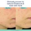 imageCetaphil Gentle Clear TripleAction Acne Treatment Serum with Salicylic Acid Treats and Prevents Acne Great for PostAcne Marks for All Skin Types 1oz